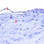 Рис. 2. Микрокартина роговицы глаза с образованием патологического эпителия: 1 – патологический эпителий; 2 – строма роговицы.