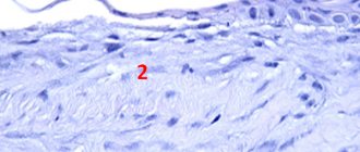 Rice. 2. Micropicture of the cornea with the formation of pathological epithelium: 1 – pathological epithelium; 2 – corneal stroma.