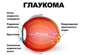симптомы глаукомы