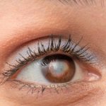 Симптомы катаракты