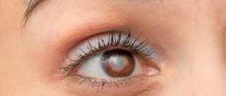 Symptoms of cataracts