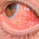 Симптомы склерита