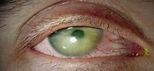 Синдром сухого глаза как осложнение лазерной коррекции