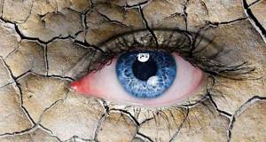 синдром сухого глаза