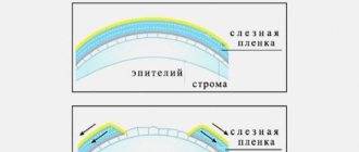 Синдром сухого глаза