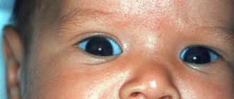 Blue sclera