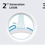 Comparison of laser vision correction methods