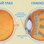 сравнение здорового глаза и больного глаукомой