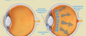 сравнение здорового глаза и больного глаукомой