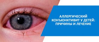 article allergic conjunctivitis in children