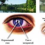 Светобоязнь глаз: причины и лечение, проявление фотофобии у детей и профилактические действия