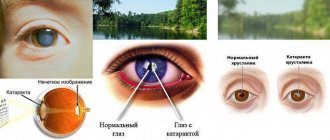 Светобоязнь глаз: причины и лечение, проявление фотофобии у детей и профилактические действия