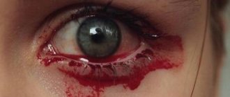 Течет кровь из глаза
