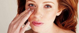 Dark circles under the eyes of a girl