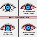 Типы конъюнктивита