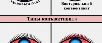 Типы конъюнктивита