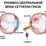 Тромбоз ЦВС глаза