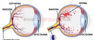 Thrombosis of the central vein of the eye
