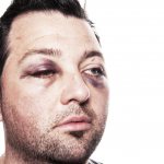 Тупые травмы глаз являются одними из самых распространенных.