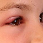 У ребенка воспалилось веко