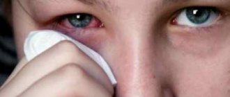 The child has an inflamed eye