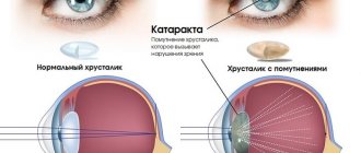 Удаление катаракты в пожилом возрасте. Последствия, послеоперационный период, противопоказания
