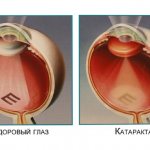 Удаление катаракты