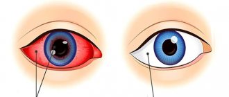 Uveitis of the eye