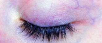Varicose veins under the eyes