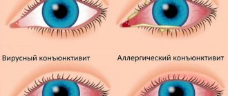 Виды и симптомы конъюнктивита