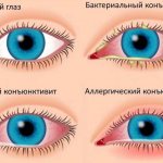 Виды и симптомы конъюнктивита