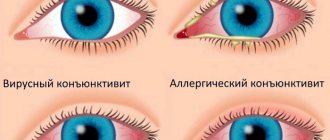 Виды и симптомы конъюнктивита