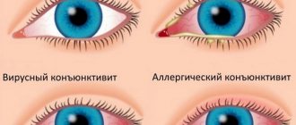 виды конъюктивита