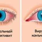 Виды конъюнктивита