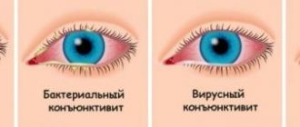 Types of conjunctivitis