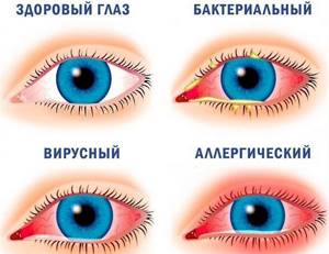 Виды воспаления глаз