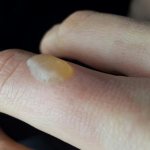 Burn blister with dry crust