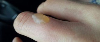 Волдырь от ожога с сухой корочкой