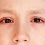 воспаление глаз