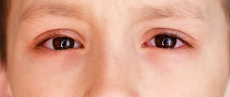 eye inflammation