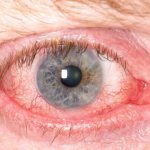 Воспаление глаза.