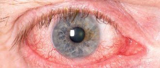 Inflammation of the eye.