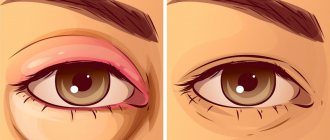 Inflammatory swelling.jpg