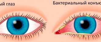 Возбудители бактериального конъюнктивита — различные патогенные бактерии