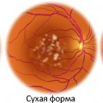 Возрастная макулярная дегенерация