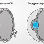 Заднекамерная и переднекамерная факичная линза