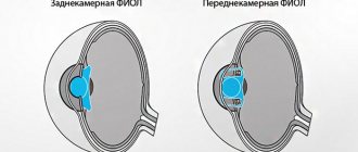 Posterior chamber and anterior chamber phakic lens