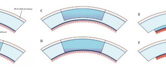 Posterior layered keratoplasty (DLEK, DSEK, DSAEK, FS-DSEK and DMEK)