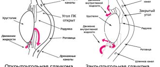 закрытоугольная и открытоугольная глаукома отличия