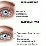 Здоровый глаз и глаз с коньюктивитом